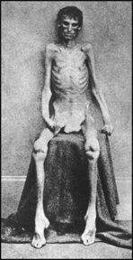 Andersonvillesurvivor