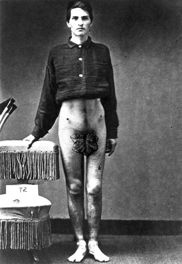 Sergeant Anson Ryder, photographed July 25, 1865, at the Army Medical Museum